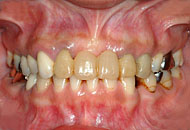 orthodontics,before,񋸐,ÑO,gvbdo,G.V. BLACK DENTAL OFFICE,
