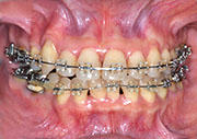 orthodontics,before,񋸐,ÑO,gvbdo,G.V. BLACK DENTAL OFFICE