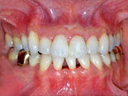 orthodontics,after,񋸐,Ì,gvbdo,G.V. BLACK DENTAL OFFICE