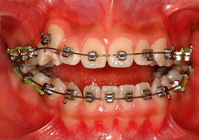 񋸐,d,w,],uO,R~,ǂ,摜,Vh,O,z,{,֍u,s,q,,Ȉ@,GVBDO,G.V. BLACK DENTAL OFFICE,