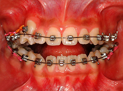 񋸐,d,w,],uO,R~,ǂ,摜,Vh,O,z,{,֍u,s,q,,Ȉ@,GVBDO,G.V. BLACK DENTAL OFFICE,