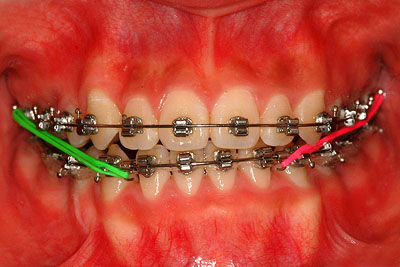 񋸐,d,w,],uO,R~,ǂ,aJ,ڍ,w|w,Ru,cz,,,g,j,e,l,,Ȉ@,GVBDO,G.V. BLACK DENTAL OFFICE,