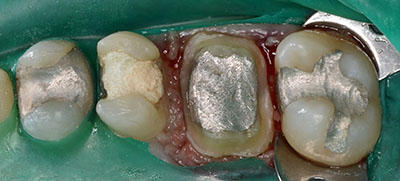 preparation,tooth,dental,`,,gvbdo,G.V. BLACK DENTAL OFFICE