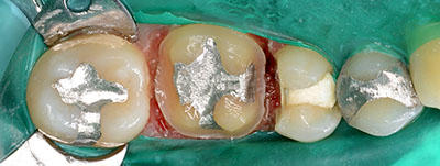 gold crown,tooth,dental,,,S[hNE,gvbdo