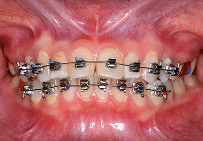 orthodontics,brace,񋸐,uPbg,gvbdo,G.V. BLACK DENTAL OFFICE
