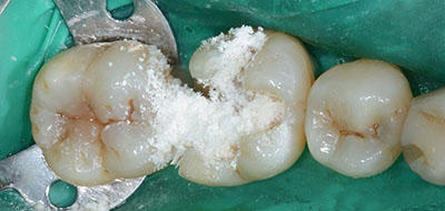 decay,dental,tooth,teeth,,,gvbdo,G.V. BLACK DENTAL OFFICE