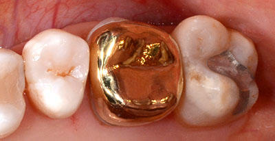 gold crown,tooth,dental,,,S[hNE,gvbdo