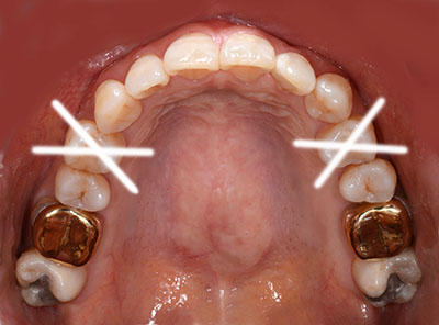 orthodontics,brace,񋸐,uPbg,gvbdo