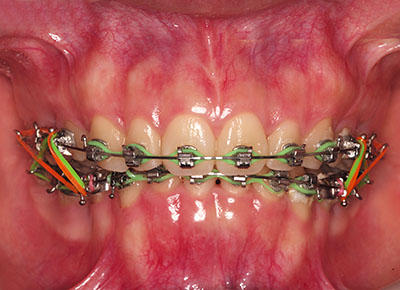 orthodontics,brace,񋸐,uPbg,gvbdo,length,how,long,ŒZ,short