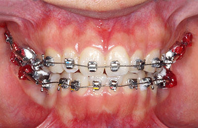 orthodontics,brace,񋸐,uPbg,gvbdo