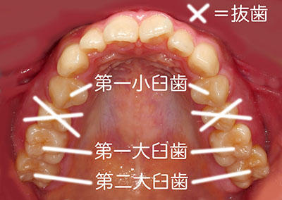 orthodontics,brace,񋸐,uPbg,gvbdo,length,how,long,ŒZ,short