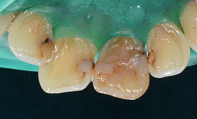 root canal, brown tooth,F,_o,,pulp, dead
