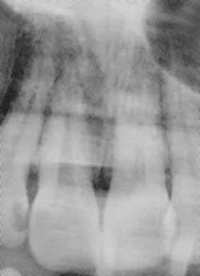 x ray, root canal, brown tooth,F,_o,,pulp, dead