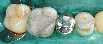 preparation,tooth,dental,`,,gvbdo,G.V. BLACK DENTAL OFFICE