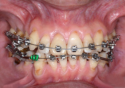 orthodontics,brace,񋸐,uPbg,gvbdo,G.V. BLACK DENTAL OFFICE