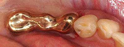 bridge,dental,teeth,prosthesis,ubW,,gvbdo