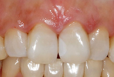 resin,composit,tooth,dental,W,R|Wbg,,gvbdo