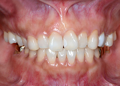 resin,composit,tooth,dental,W,R|Wbg,,gvbdo
